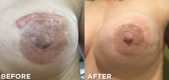 Areola Tattoo Revision
