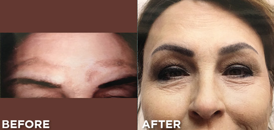 Eyebrow Revision
