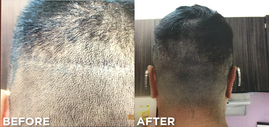 Scalp Micro Pigmentation Camouflage